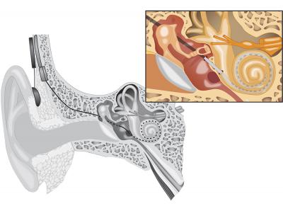 kochlearine implantacija 01